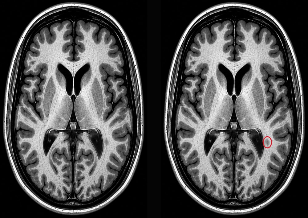 Illustrative axial brain MRI shown twice. Both images contain the same faint shadow in the white matter beside the left lateral ventricle. In the second image, it is outlined in red for review.